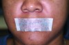 Fig 3. Paper tape seals the mouth, assuring nasal breathing. The tape is porous enough to allow oral breathing, if necessary. The tape can be worn vertically leaving the sides of the lips open. Patients with long histories of mouth breathing may find it easier to accept.