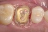 Figure 3  Gingivoplasty completed. Note the quality of the gingival retraction and the dryness of the field.