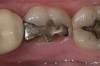 Figure 9  Preoperative view. The significant gingival overgrowth made it difficult to evaluate the extent of the condition.