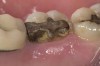 Figure 10  Preoperative view. The significant gingival overgrowth made it difficult to evaluate the extent of the condition.