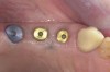 Figure 13  Healing abutments placed for Replace¬Æ Select implants (Nobel Biocare USA LLC, Yorba Linda, CA). Note how the gingival tissue healed against the abutments.
