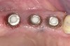 Figure 14  The gingival tissues were contoured with a diode laser, creating the cervical contours of the crowns.