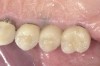 Figure 16  Final crowns cemented. A soft-tissue laser can serve as a diagnostic tool, as the hyperplastic tissue can be excised easily, maintaining a blood-free environment. This affords better visibility for evaluating the depth of the tooth fracture.
