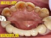 Fig 6. Wear of maxillary dentition (top) opposing a PFM fixed partial denture.