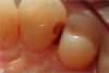 Fig 4 and Fig 5. A matrix now could easily be placed, and the Class III composite filling could be completed. Reestablishment of gingival tissues should occur in about 14 days.