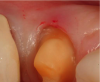 Fig 6. The thick tissue could make it difficult to place retraction cord around this premolar.