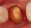 Fig 7. An electrosurgery unit was used to create a trough around the tooth.