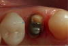 Fig 8. Better access on the palatal of this premolar was desirable to obtain a good impression of not just the margin but also 0.5 mm of the tooth and root surface apical to the margin.