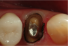 Fig 10. Double-zero retraction cord was then placed circumferentially around the entire tooth at the base of the sulcus. Number 1 cord would then be placed at the level of the margin.