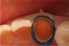 Fig 17. When the second cord was placed, a small amount of tissue was noted hanging over the top of the cord on the mesial, next to the lateral incisor. To avoid creation of a void or irregularity in the final master impression, an electrosurgery unit can be used to remove such tissue.