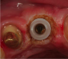 Fig 19. The incisal aspect of the zirconia abutment, after use of the electrosurgical unit to sculpt the tissue.