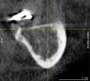 Fig 3. Presurgical cross-sectional CBCT scan slice of an All-on-4–style dental implant patient with crestal location of the inferior alveolar nerve (yellow crosshairs on nerve) secondary to bone resorption. Bone reduction in this location risks exposure and damage to the nerve.
