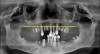 Fig 4. Presurgical panoramic radiograph of an All-on-4–style patient with pneumatized maxillary sinuses that extend beyond the planned horizontal plane of bone reduction (yellow line).