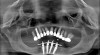 Fig 14. Postsurgical panoramic radiograph of All-on-4–style dental implant surgery with dental implants engaging cortical bone at the inferior border of the mandible.
