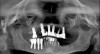 Fig 16. Presurgical panoramic radiograph of a patient receiving All-on-4–style treatment with multiple dental implants requiring explantation. Note the dental implants in the mandibular right quadrant that are compromising the inferior alveolar nerve.