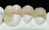 Fig 8. Pressed and stained lithium disilicate ceramic restorations on the master cast.