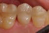 Fig 12. Color of the abutment is matched to adjacent prepared teeth to help blend between implant-supported restorations and natural tooth-supported restorations.