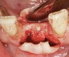 Figure 1 A round bur is used to create a notch where the osteotomy will be initiated. It helps prevent chatter when the osteotomy is being started.