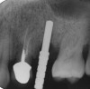 Figure 8  The twist drill should be used to create the initial osteotomy to 5 mm, then a guide pin is employed to check the angulation of the osteotomy.