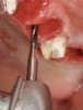 Figure 9  The Lindemann bur (side-cutting) can be used to laterally reposition the initial osteotomy created with the twist drill.