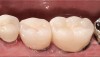 Figure 15b  Cement-retained crowns in place.