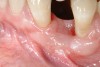 Figure 8  Adequate keratinized and attached gingiva after free gingival graft surgery.