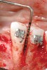 Figure 14  Interproximal bone present at teeth Nos. 21 and 22, postorthodontics.