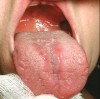 Figure 1  Evidence of candidiasis in the form of erythematous, atrophic patches on the dorsal surface of the tongue (median rhomboid glossitis) and erythema of the soft palate. The patient was using an inhaler and wearing a   denture and was a smoker.