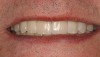 Figure 5e  Final prosthesis. Smile view.