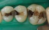 Figure 8. Teeth after removal of amalgams.