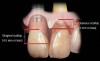 Figure 1  The relationship of the interproximal papilla height to the interproximal bone of the adjacent tooth is 4.5 mm.