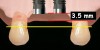 Figure 4  If the interproximal crest of bone is between adjacent implants, the average papilla height above the bone is 3.5 mm (ie, red line), which results in a significant difference in papilla height when compared to the pre-extraction papillary height (ie, yellow line).