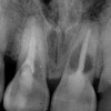 Figure 6  Excellent interproximal crestal bone level between the centrals before extraction.