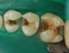 Figure 9. Prepared teeth after removal of decay and cracks.