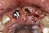 Figure 17  Connective-tissue grafting in the pontic area of No. 9 and over the implant site No. 10.