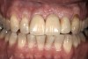 Figure 18  Final restoration was achieved with a three-unit zirconia prosthesis: No. 8—implant abutment, No. 9—pontic, and No. 10—abutment.