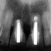 Figure 20  Soft-tissue levels were acceptable, but significant bone loss was present.