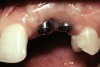 Figure 25  A patient presented with a significant ridge defect, but with surgeon-placed adjacent implants in the lateral and cuspid positions.