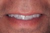 Figure 1  Preoperative facial view demonstrating maximum tooth display.