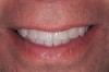 Figure 9  Immediate post-orthodontic facial view.
