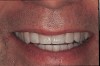 Figure 10  Two-year post-orthodontic facial view showing the completed composite veneers on the lateral incisors.