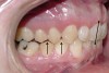 Figure 4  Palatally inclined upper central incisors  indicating a negative torque. In this situation the first  point of contact upon closure occurs in these teeth  leading (Occlusal Fence I) to a posterior shift and  distalization of the mandible.