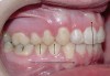 Figure 5  After orthodontic correction, the upper  central incisors have a positive torque, and the posterior  shift of the mandible on closure is eliminated.