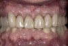 Figure 9  View at 10 weeks post-surgery showing the new gingival level. The preparation and temporary will now be extended to the gingival level.