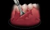 Figure 5  A periosteal elevator is used to create a full thickness elevation apical to the mucogingival junction.