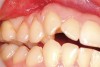 Figure 14  Gingival recession on the first and second maxillary premolars with a thin band of attached gingiva.