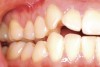 Figure 15   Correction of the attached gingiva and repair of the recession shown 8 weeks postsurgery.