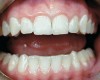 Figure 2  Moderate caries risk patient.