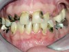 Figure 4  Extreme caries risk patient with high activity.