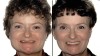 Figure 4  Before and after photographs of the patient seen in Figure 3 after double-jaw surgery to rotate the mandible and the maxilla inferiorly, increasing tooth display and anterior facial height.